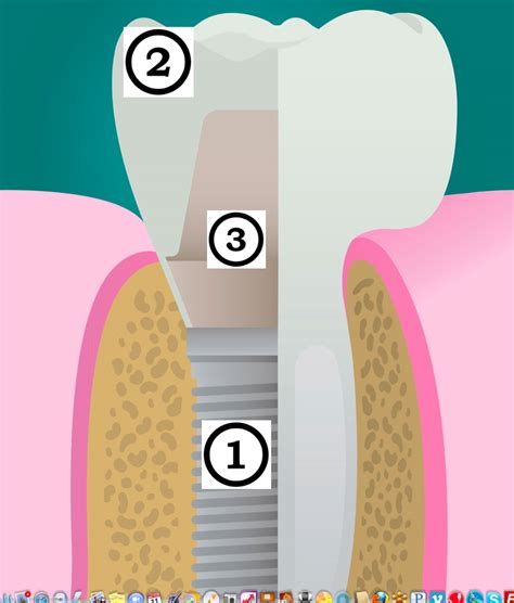 customized abutment   dental implant