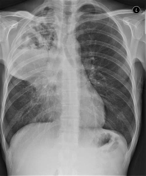 lung abscess definition  symptoms diagnosis treatment
