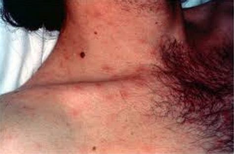 hiv rash pictures images symptoms on armpit legs