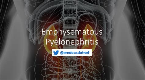 emdocsnet emergency medicine educationemphysematous pyelonephritis
