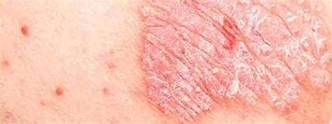 psoriasis  treatment symptoms medications