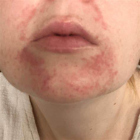 face mask  trust   sensitive  dermatitis prone skin