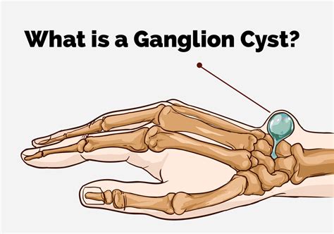 ganglion cyst countryside orthopaedics