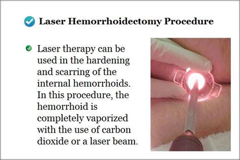 Laser Surgery For Hemorrhoids Treatment Hemorrhoids