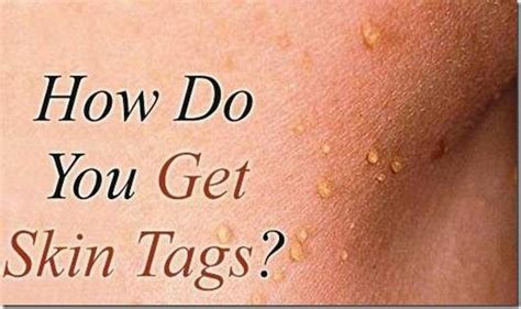 skin tag removal methods causes of skin tags skin tag