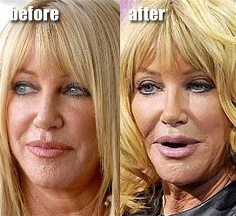 Reviews And Facts Of Suzanne Somers Plastic Surgery