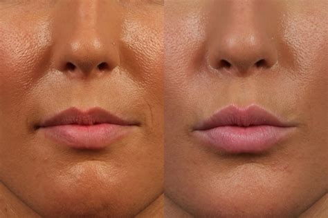 avoid lip filler mistakes dr brett kotlus cosmetic oculoplastic