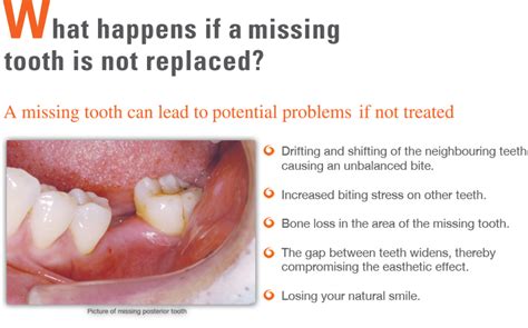 replace  missing teeth  face  consequences dr nechupadam dental clinic