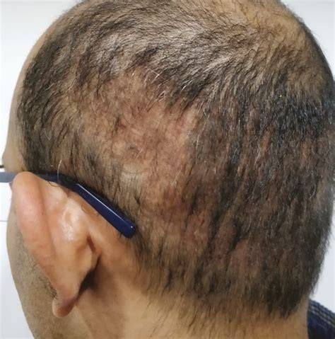 donor area telogen effluvium  hair transplant lahore pakistan clinic