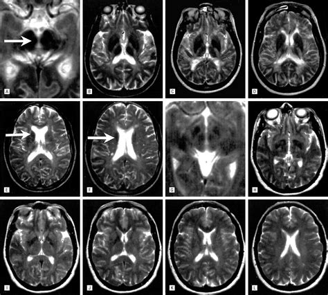 T2 Hypointensity In The Deep Gray Matter Of Patients With Multiple