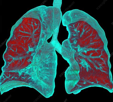 Normal Lungs Ct Scan Stock Image C016 6691 Science Photo Library