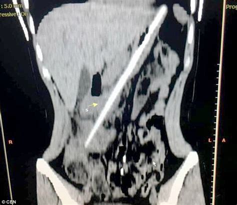 chopstick is removed from chinese woman s stomach after she swallowed