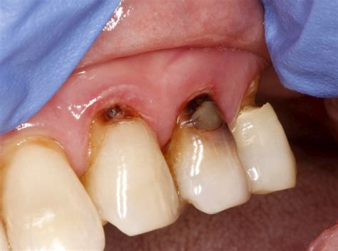 tooth decay   root surface mccarl dental group