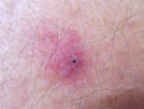 tick bites pictures symptoms  treatment medical treasure