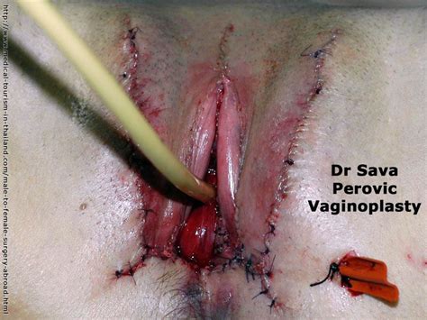 surgical penis to vagina transformed mega porn pics