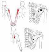 Infraspinatus Trigger Point Pain Referred Muscle Shoulder Arm Teres Minor Rotator Triggerpoints Points Triggerpunkte Cuff Back Upper Guide Supraspinatus Schultergelenk sketch template