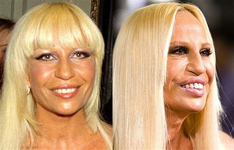 Two Faced Drastic Before And After Celebrity Plastic Surgery