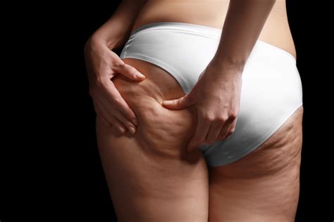 emtone cellulite treatment dr shel wellness and aesthetic