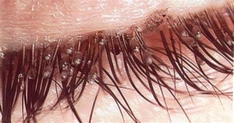 Eyelashes Pediculosis Symptoms