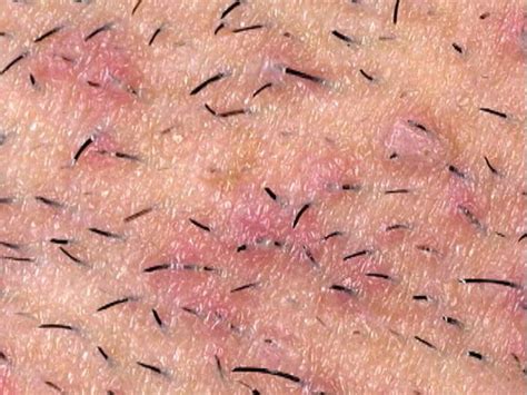 Healthy Living Goes Deep Into Ingrown Hairs