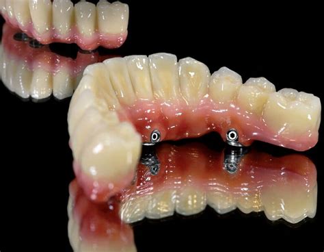 overdentures fixed removable