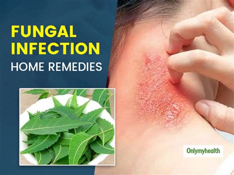 fungal skin infection bothering     home remedies
