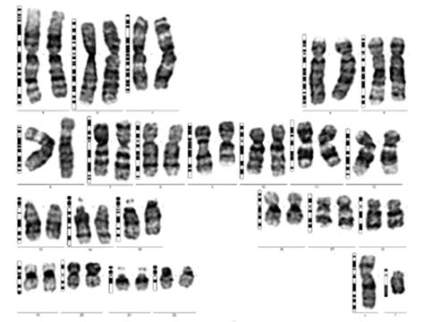 Karyotype 46 Xy T 9 15 Q21 2 P11 2 Inv 9 Download Scientific Diagram