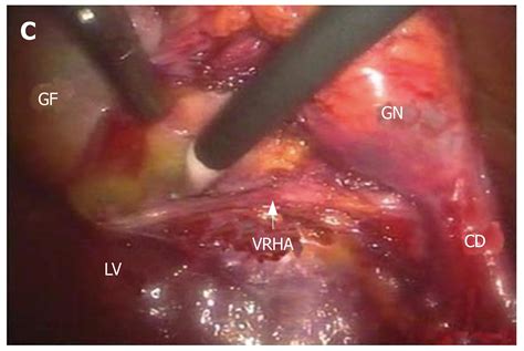 New Classification Of The Anatomic Variations Of Cystic