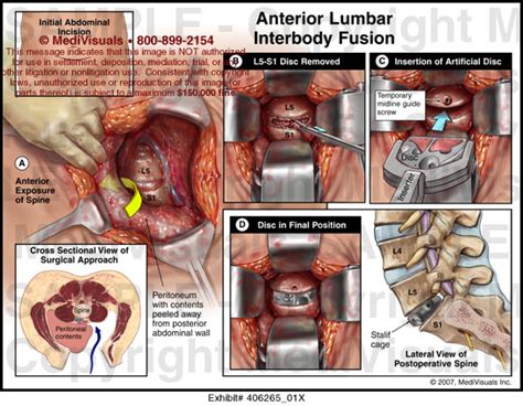 Anterior Lumbar Interbody Fusion Medical Illustration