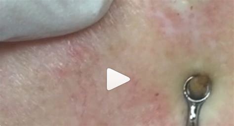 This Viral Instagram Page Is Entirely Dedicated To Pimple