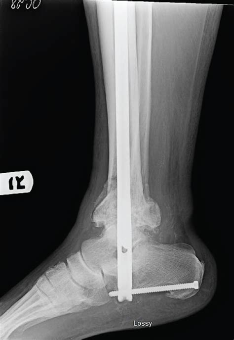 catastrophic hindfoot collapse  tibiotalocalcaneal nailing  case