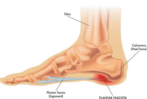 cure plantar fasciitis   week   physical therapist