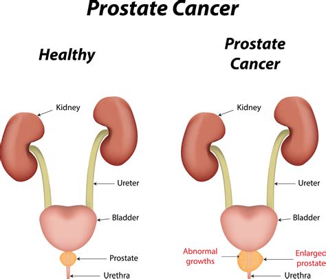 Prostate Cancer Diagnosis And Risk Currae Hospitals