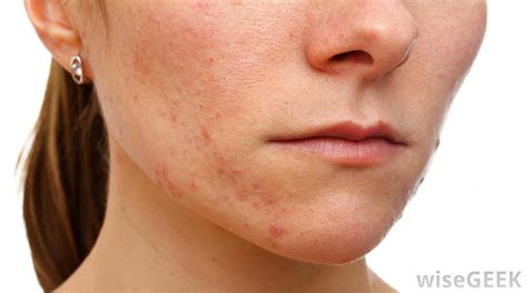 Best Acne Scars Treatment Products Facts About Acne And