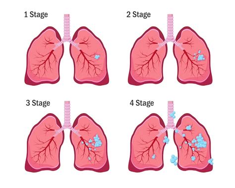Premium Vector Lung Cancer Concept Four Stages Of Lung Cancer Disease