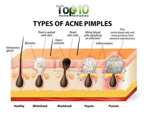 home remedies for pimples top 10 home remedies