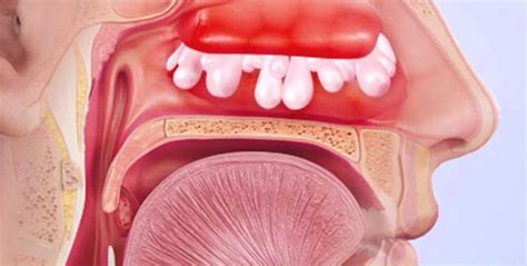 Mucus In Nose For Weeks