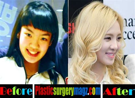 Girls Generation Plastic Surgery Is Finally Revealed