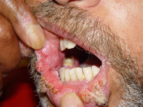poze medicale psoriazis lupus eritematos lichen plan pitiriazis rozat afectiuni cu leziuni