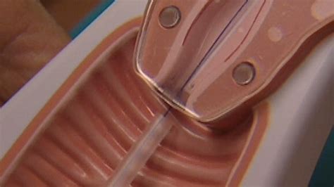 iuds implants are best birth control methods for teens