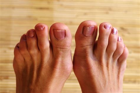 common toe problems    feet  abnormal