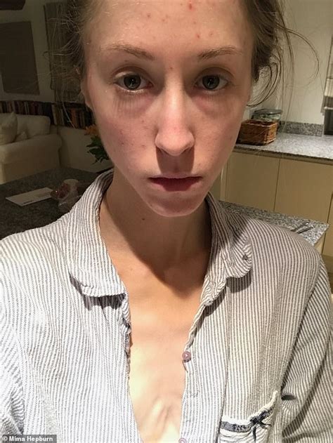 anorexia survivor 22 shares her diary of daily battle during