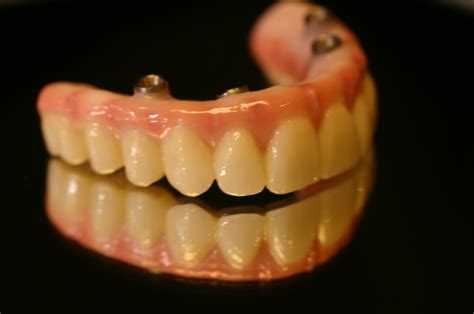 implant supported dentures ueckert dentistry