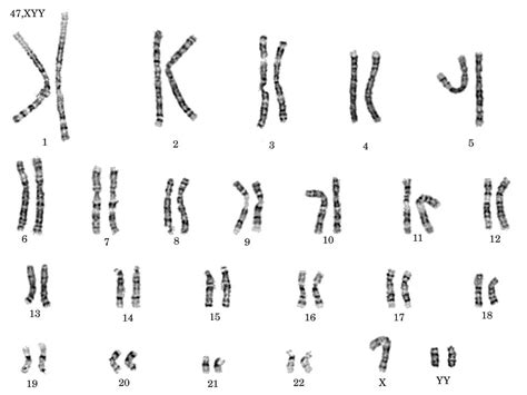Enfermedades Mutaciones Cromosómicas