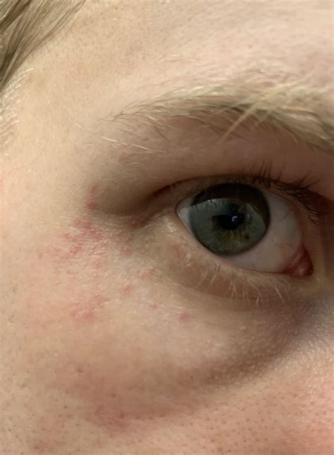 skin concern small red bumps  eyes  sides