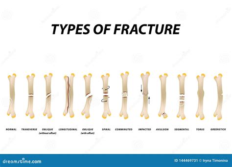 types  fracture fracture bone set infographics vector illustration  isolated background