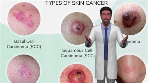 causes of skin cancer men s health issues male health clinic