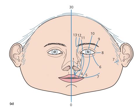 craniofacial clefts classification illustrations examples