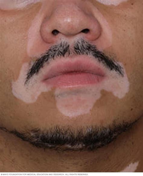 vitiligo symptoms   mayo clinic