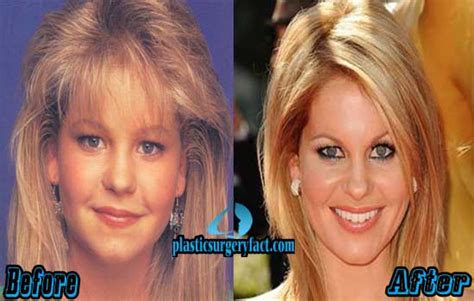 Candace Cameron Plastic Surgery Before And After Plastic